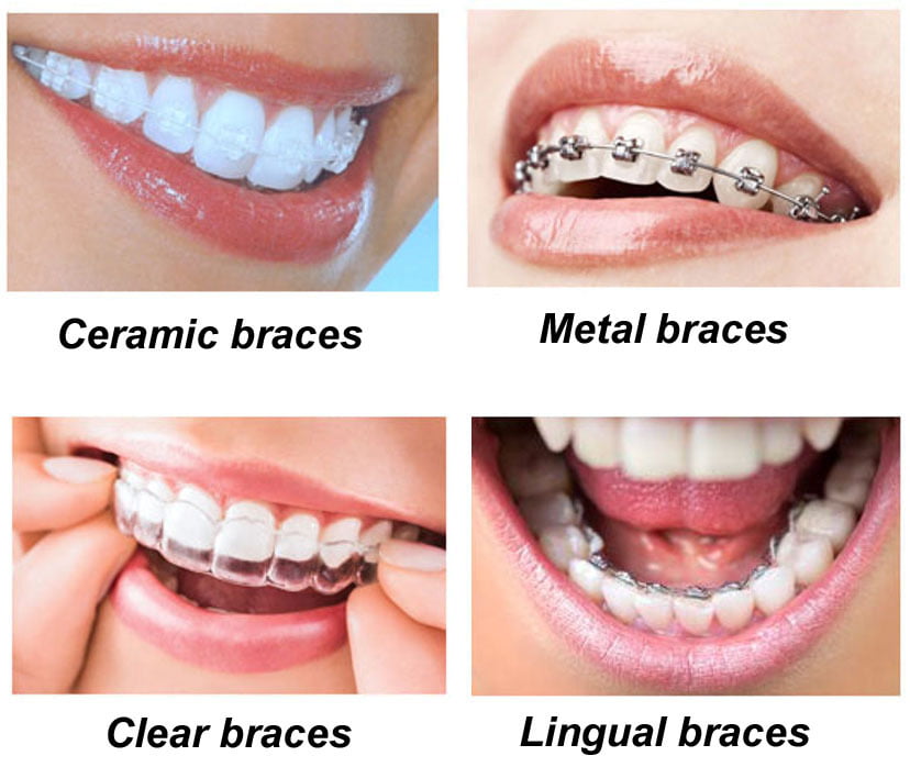 ITS DENTAL COLLEGE ORTHODONTICS