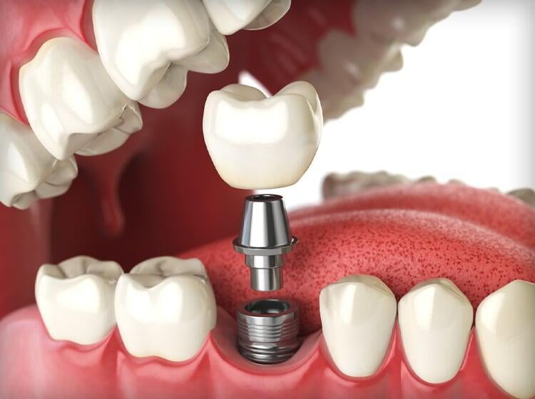 Dental Implants at ITS Dental College