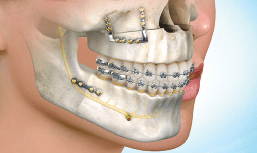 ITS DENTAL COLLEGE MAXILLOFACIAL SURGERY